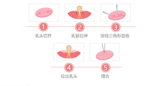 什么是乳头,乳晕整形术?